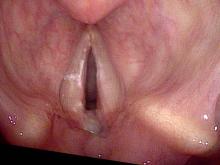 the left vocal cord granuloma slides beneath the right vocal cord