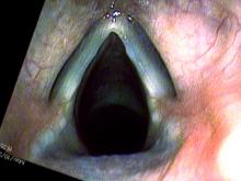 4 months after excision of vocal cord nodules