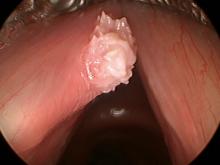 verrucous keratosis viewed during surgery with a 30° endoscope