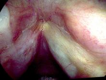 verrucous keratosis lesion 2 weeks after excision