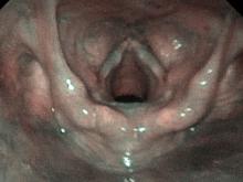 child with vocal nodules viewed with Olympus ENF-V3 endoscope