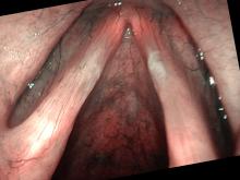 vocal nodules viewed with Olympus ENF-VH and NBI color