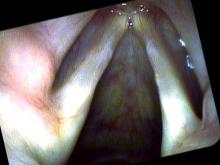 vocal nodules viewed with Pentax VNL-1590 STi and iScan color