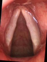 vocal nodules viewed with 90° endoscope and Toshiba camera