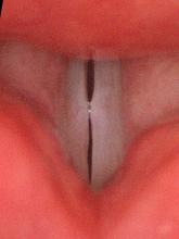 vocal nodules viewed with 90° endoscope and Toshiba camera during stroboscopy