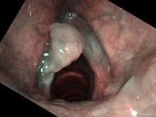 smoker's polyps viewed with Olympus ENF-VH and NBI color