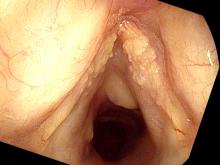 Fungal laryngitis from Flovent