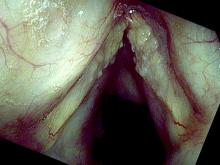 Fungal laryngitis from Flovent