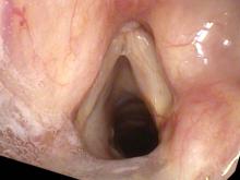 Fungal laryngitis from Flovent resolved after treatment with fluconazole