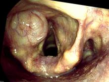 internal laryngocoele