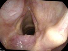 internal laryngocoele