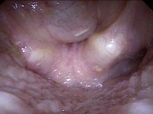 internal laryngocoele during phonation, the laryngocoele is compressed over the laryngeal opening