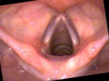 Normal young female vocal cords