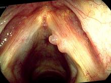 Hemorrhagic vocal cord polyp, bilobed, on the right vocal court