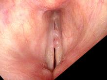 Hemorrhagic vocal cord polyp during stroboscopy