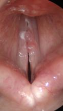 Hemorrhagic vocal cord polyp examination with rigid endoscope