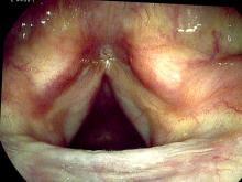 verrucous keratosis lesion six months after excision