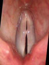 vocal nodules