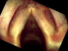 Hemorrhagic vocal cord polyp, healing one week after surgery