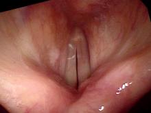 Hemorrhagic vocal cord polyp