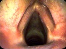 Hemorrhagic vocal cord polyp on right vocal cord margin