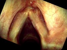 Hemorrhagic vocal cord polyp two weeks after excision