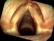 Hemorrhagic vocal cord polyp one month after excision
