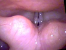 the vocal cyst projects out from the edge of the vocal cord preventing closure during phonation