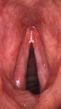 Vocal cord leukoplakia in a smoker