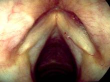 The hemorrhagic vocal cord polyp has either shrunk or fallen off and a new polyp formed