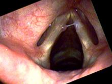 Hemorrhagic vocal cord polyp on the left side with secretions sticking on the right