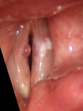  Laryngeal stroboscopy taken during open phase