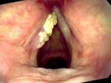 Exophytic leukoplakia of the left vocal cord with filtered lighting