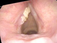 Exophytic leukoplakia of the left vocal cord