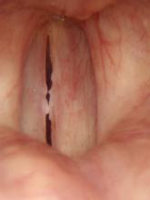 Fungal laryngitis from Advair inhaler