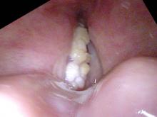 Exophytic leukoplakia of the left vocal cord during stroboscopy