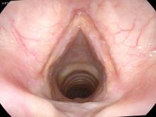 cutaneous vocal cord sarcoid