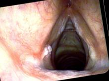 Central vocal cord leukoplakia and left vocal process granuloma