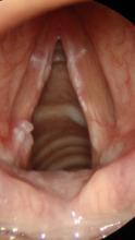 Central vocal cord leukoplakia and left vocal process granuloma