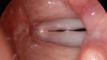 Vocal cord margins when viewed at high pitch, lesions are revealed