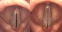 Left: the vocal cords are vibrating at a low pitch. Right: at a high pitch the CT muscle has stretched the vocal cords.