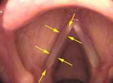 The thyroarytenoid (TA) muscle creates the bulk of the mass within the vocal cord. Arrows outline the generally visible mass of the muscle when viewed from above.